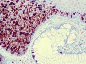 #thelancetoncology #exclusif #canceranal #HPV #nivolumab Nivolumab dans cancer métastatique l’anus préalablement traité (NCI9673) étude multicentrique phase simple bras