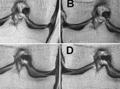 ARTHROSE OBÉSITÉ Pourquoi perte poids priorité Radiology