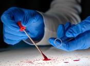 CANCER SEIN test sanguin peut prédire récurrence