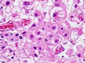 #thelancetoncology #carcinomehépatocellulaire #tivantinib #sorafenib Tivantinib pour traitement deuxième intention carcinome hépatocellulaire avancé niveau élevé d’expression (METIV-HCC) analyse finale d’une étude...
