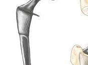 Luxation prothèse totale hanche (PTH)