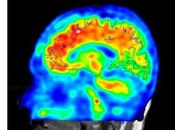ALZHEIMER L’intrusion sémantique pour détection plus pratique