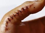 Suturer plaie méthodes délai retrait points suture