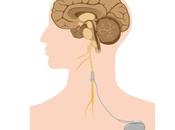 POLYARTHRITE RHUMATOÏDE stimulation nerf vague confirme efficacité