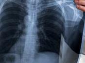 EMPHYSÈME pollution, facteur risque autant tabac