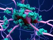 ALZHEIMER maladie émergeait tout début
