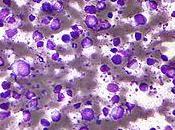 #thelancet #lymphome #lymphomeàgrandescellulesB Lisocabtagene maraleucel pour patients atteints lymphomes grandes cellules (TRANSCEND 001) étude multicentrique conception homogène