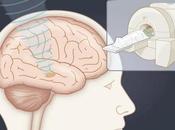 PARKINSON L’échographie focalisée symptomatologie asymétrique