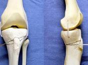 ARTHROSE GENOU L'ostéotomie tibiale, alternative l’arthroplastie totale