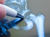 OSTÉOPOROSE revêtement tout doux amortit l’implant osseux