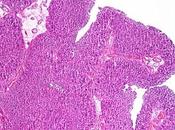 #thelancetoncology #carcinomeurothélial #atezolizumab Atezolizumab adjuvant versus observation dans carcinome urothélial invasif plan musculaire (IMvigor010) essai multicentrique phase randomisé ouvert