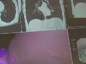 nouvelle technologie type Trumbull Regional Medical Center aide détecter cancer poumon