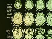 Maladie HUNTINGTON L'autophagie synaptique, cible thérapeutique