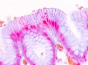 MICI mutation génétique fait fuir l’intestin