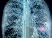 #thelancetrespiratorymedicine #cancerdupoumon #dépistage Faisabilité dépistage cancer poumon dans régions défavorisées