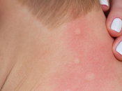 Allergie piqûres d’insecte symptômes, traitements