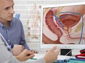 CANCER PROSTATE Lipoprotéine cholestérol, facteurs mieux décrypter