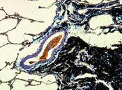 PNEUMOCONIOSE L'autre grande nuisance charbon