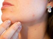 solutions pour lutter contre l’acné chez adultes