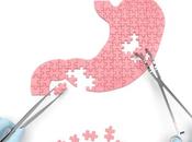 CHIRURGIE BARIATRIQUE Bénéfique aussi continence urinaire