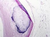 ATHÉROSCLÉROSE plaque plus tardive mais nocive chez femmes ménopausées